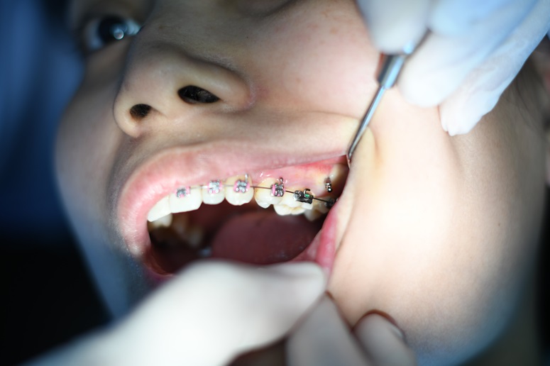 Dentist applying braces