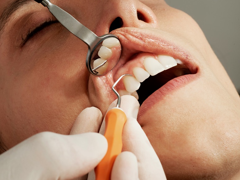 Patient getting cavity filled