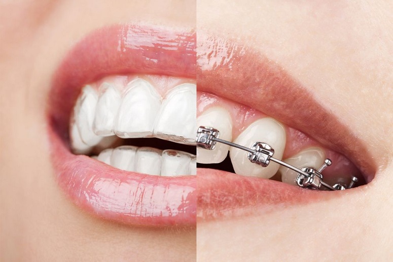 Comparison of Invisalign and standard braces