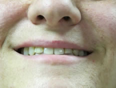 uneven teeth before dental work