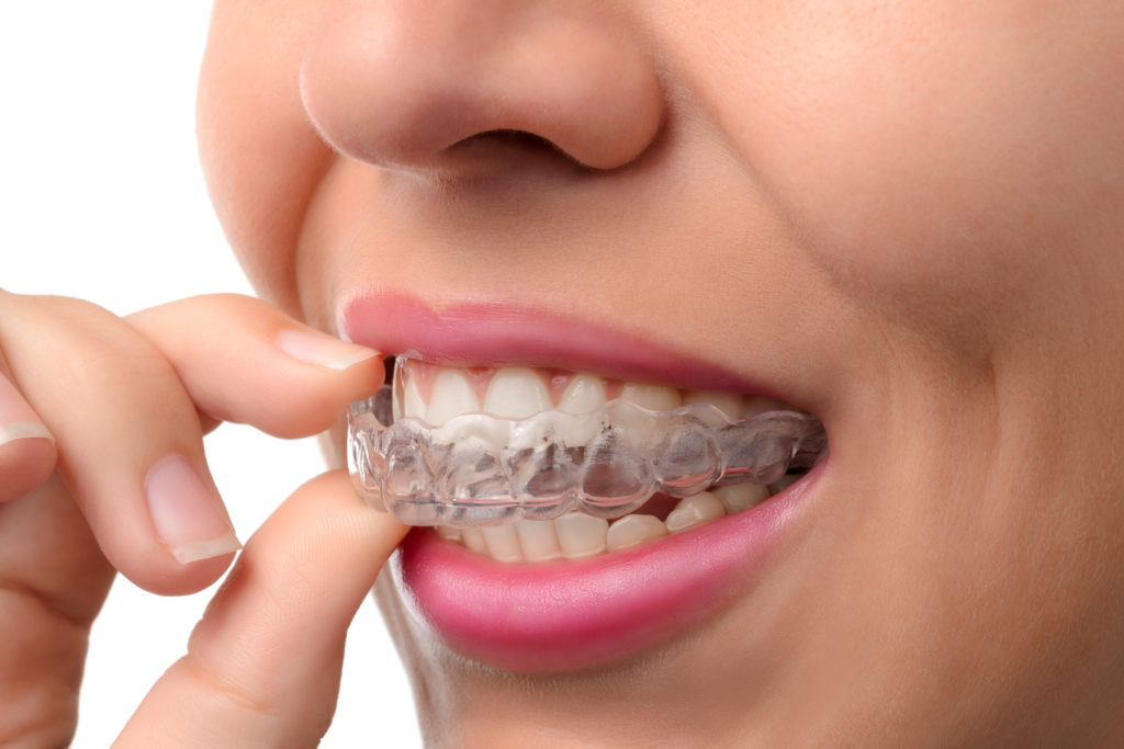 A female places a transparent mouth guard over her top teeth